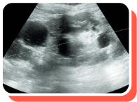Kidney Length Ultrasound