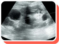 Kidney Length Ultrasound